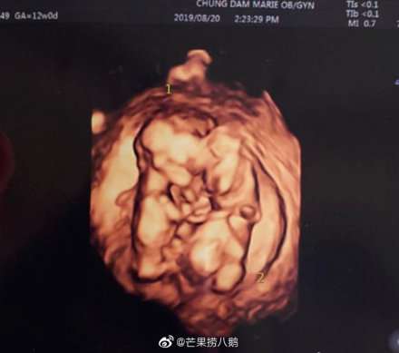 崔珉焕金律喜二胎为双胞胎 赞儿要当哥哥了！