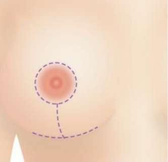 乳晕 乳晕